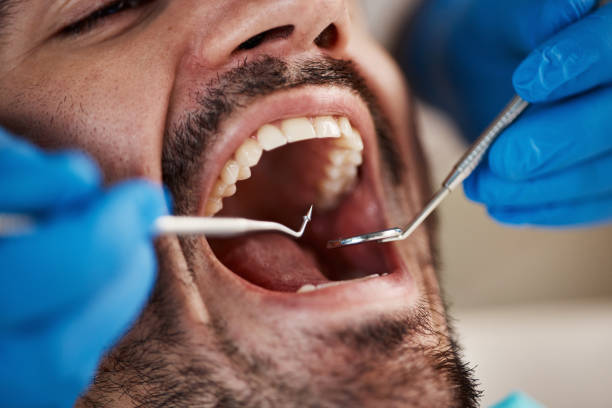 Best Knocked-Out Tooth (Avulsed Tooth) Treatment in Crestview, FL